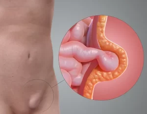 Hernia Surgery in Jaipur