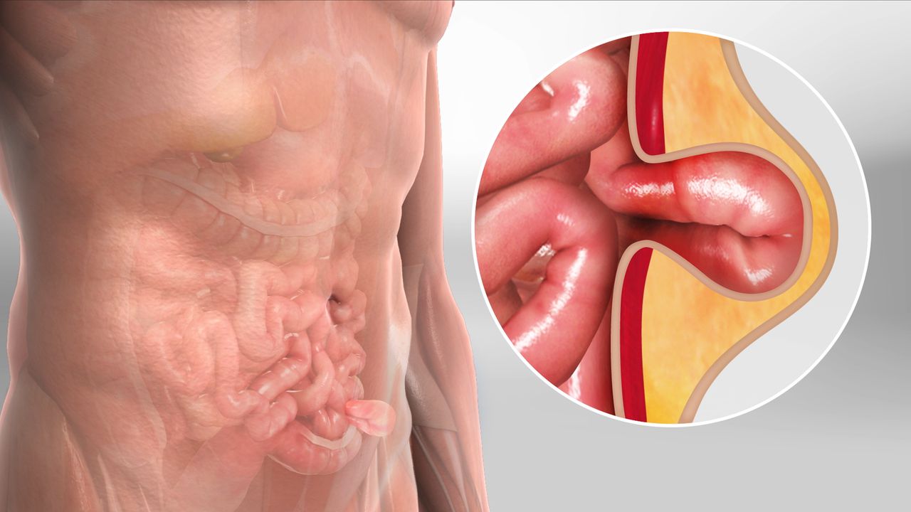 Hernia Repair Surgery
